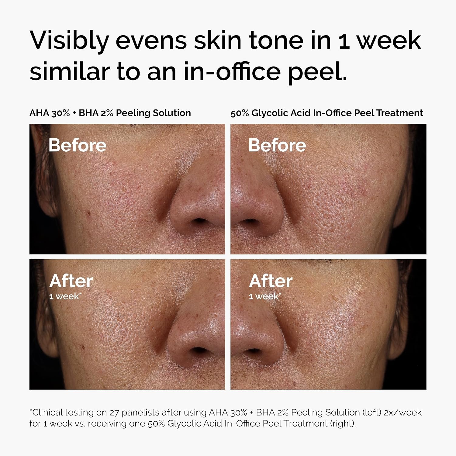 image:imageThe Ordinary AHA 30 BHA 2 Peeling Solution Advanced Exfoliating Peel for Brighter SkinAHA 30 BHA 2 Peeling Solution