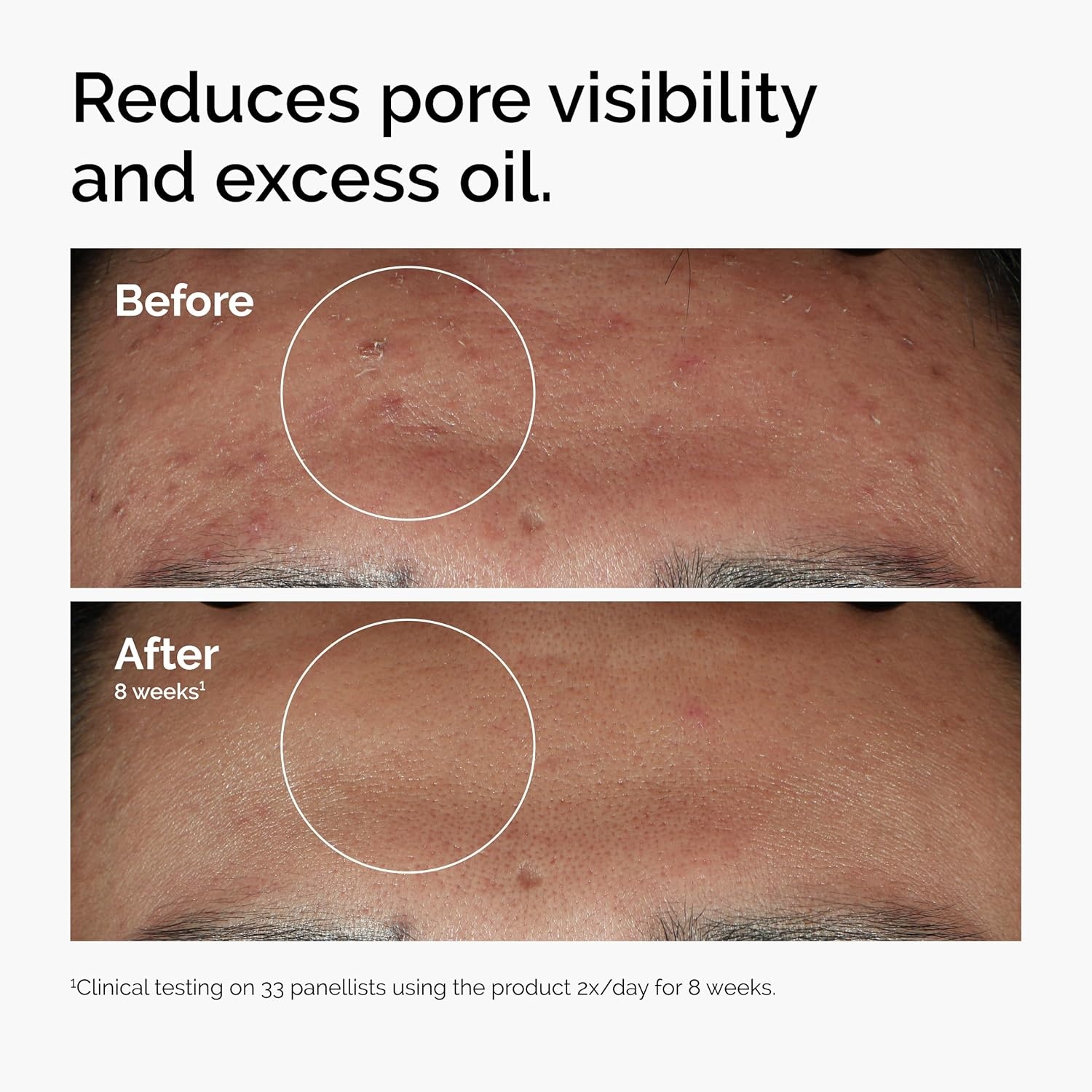 image:imageThe Ordinary Niacinamide 10 Zinc 1 Smoothing Serum for BlemishProne Skin1 Fl Oz Pack of 1