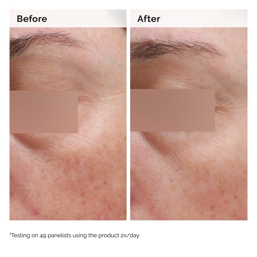 image:imageThe Ordinary Niacinamide 5 Face and Body Emulsion Dark Spot amp Skin Tone Corrector 34 Fl Oz