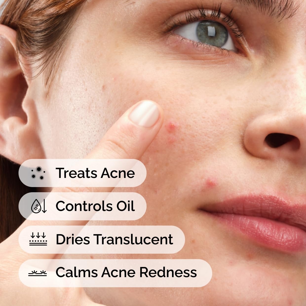 image:imageThe Ordinary Sulfur 10 PowdertoCream Acne Spot Treatment Concentrate Reduces Pimple Size and Zit Redness 018 Oz018 Ounce Pack of 2