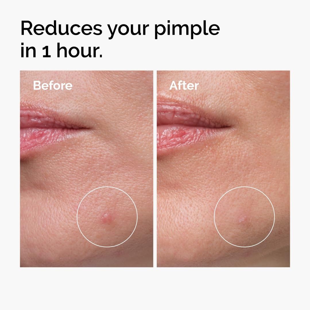 image:imageThe Ordinary Oil Control Duo Blemish Skin Care Set Niacinamide 10 Zinc 1 and Sulfur 10 PowderToCream Concentrate