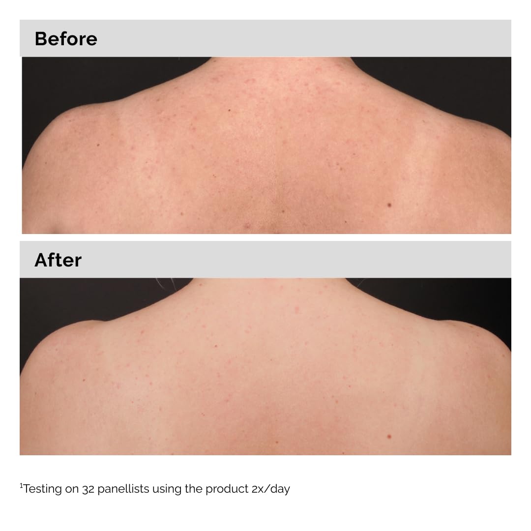 image:imageThe Ordinary Salicylic Acid 05 Body Serum Exfoliating Treatment for AcneProne Skin 81 Fl Oz